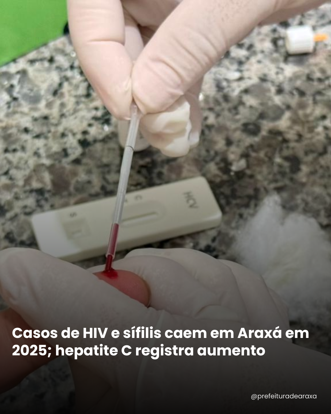 Casos de HIV e sífilis caem em Araxá em 2025; hepatite C registra aumento